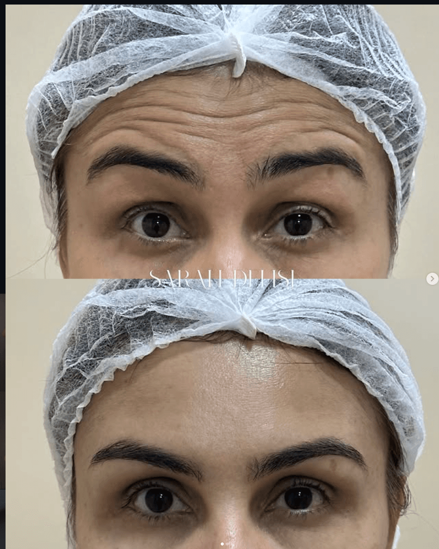 Toxina Botulínica — Botox